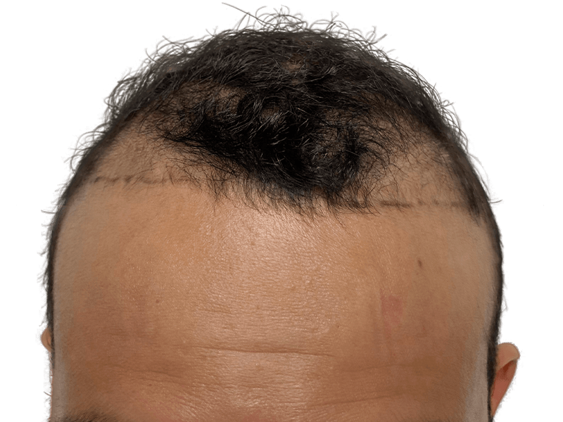 Hair transplant before & after: Man with receding hairline marked for restoration. See potential hair growth results.