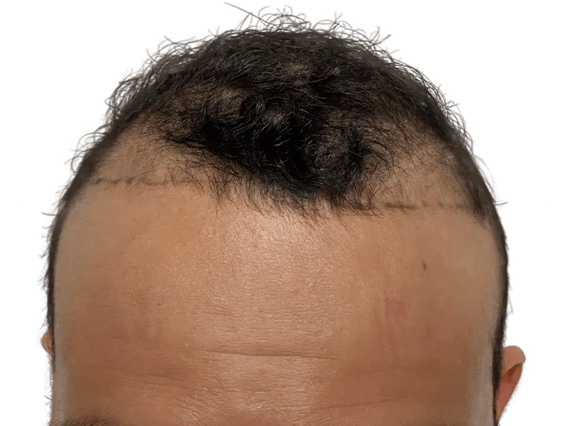 Hair transplant before & after: Man with receding hairline marked for restoration. See potential hair growth results.