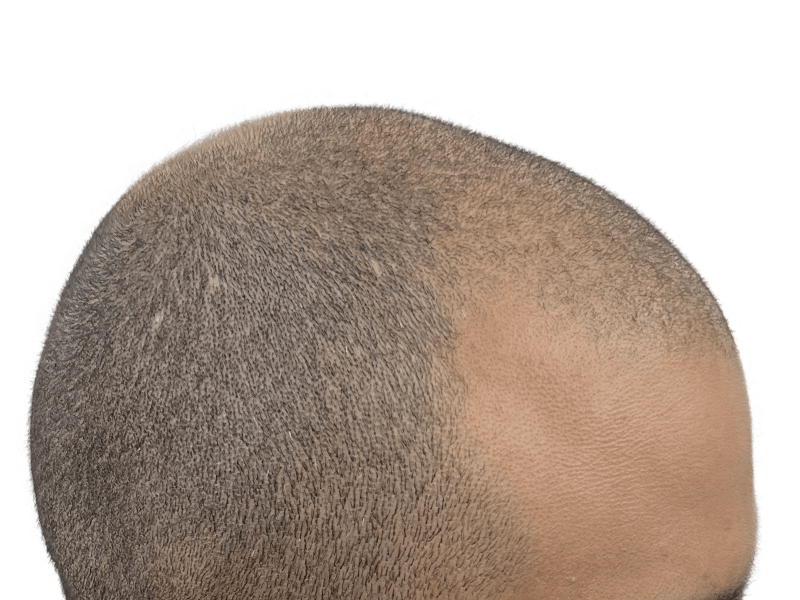 Hair transplant progress: shaved head showing hair growth on left, thinning on right. Hair restoration results.