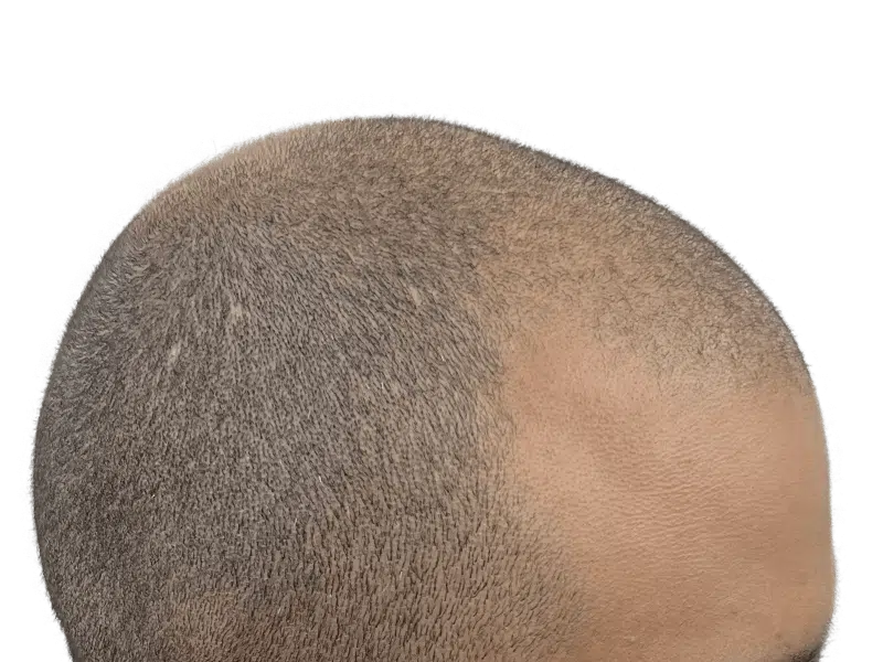 Hair transplant progress: shaved head showing hair growth on left, thinning on right. Hair restoration results.