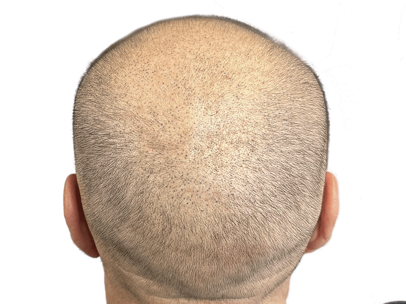 Thinning hair on light skin. Potential hair transplant candidate. Hair restoration before/after assessment.
