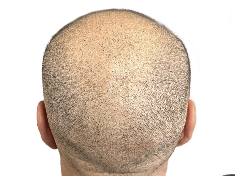 Thinning hair on light skin. Potential hair transplant candidate. Hair restoration before/after assessment.