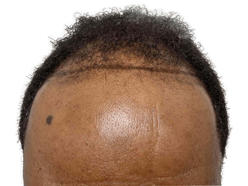 Hair transplant result: African American man's restored hairline. Fuller, natural-looking hair growth. Before & after transformation.
