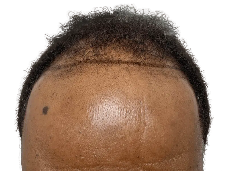 Hair transplant result: African American man's restored hairline. Fuller, natural-looking hair growth. Before & after transformation.