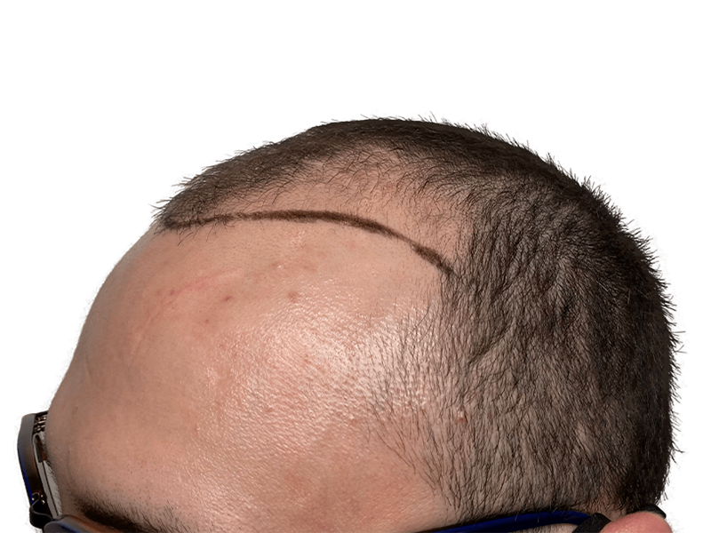 Hair transplant result: Dark, dense hair growth after procedure. New hairline marked. Before/after hair restoration.