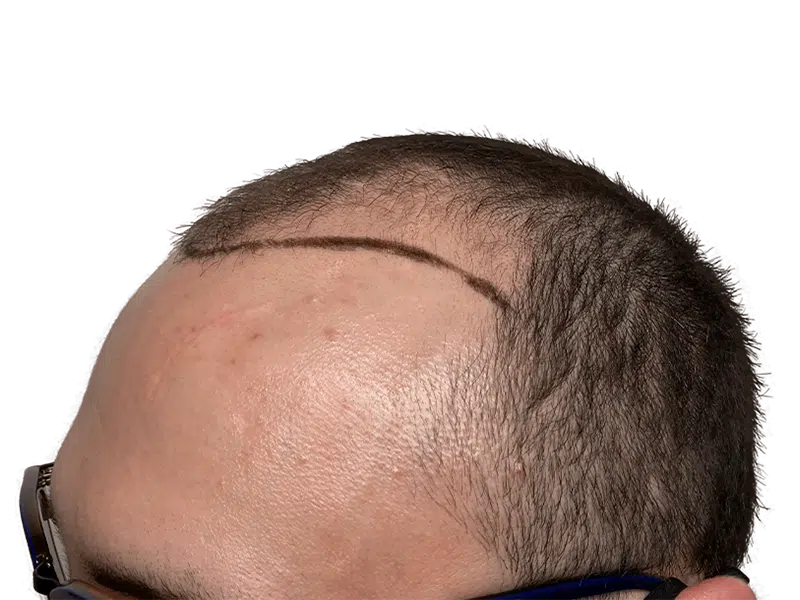 Hair transplant result: Dark, dense hair growth after procedure. New hairline marked. Before/after hair restoration.
