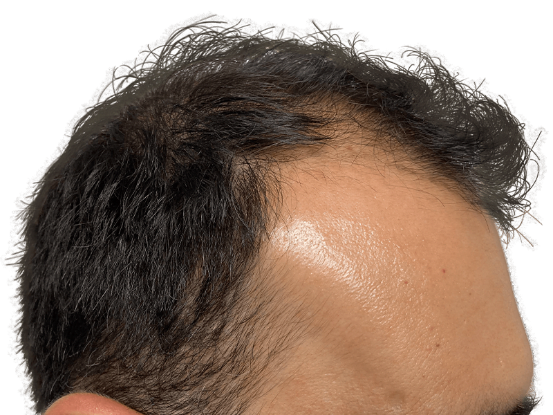 Thinning hairline. Dark hair, possible hair loss. Hair restoration or transplant consultation? Before/After potential.