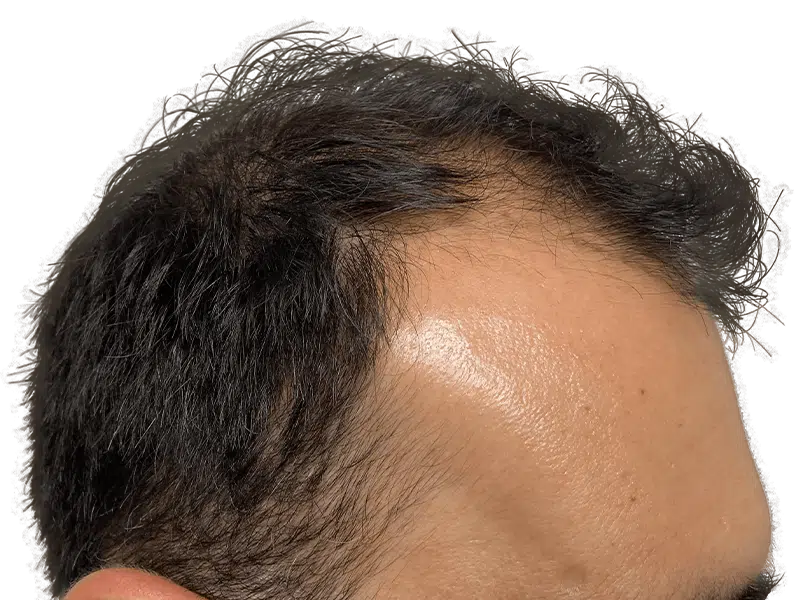 Thinning hairline. Dark hair, possible hair loss. Hair restoration or transplant consultation? Before/After potential.