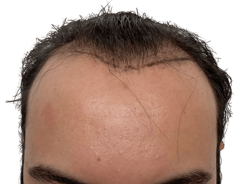 Hair transplant result: Close-up of hairline showing restored hair growth. Before & after comparison possible.