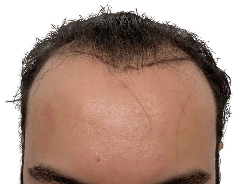 Hair transplant result: Close-up of hairline showing restored hair growth. Before & after comparison possible.