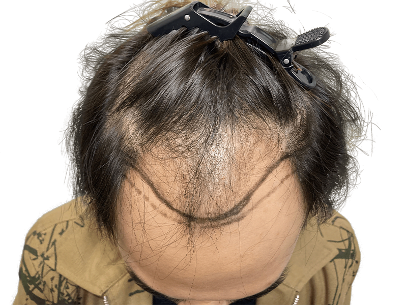 Before hair transplant: Marked hairline for restoration. Dark hair, light skin. Hair loss assessment.