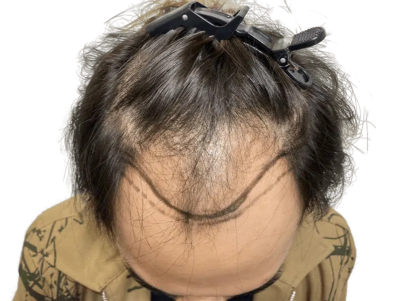 Before hair transplant: Marked hairline for restoration. Dark hair, light skin. Hair loss assessment.