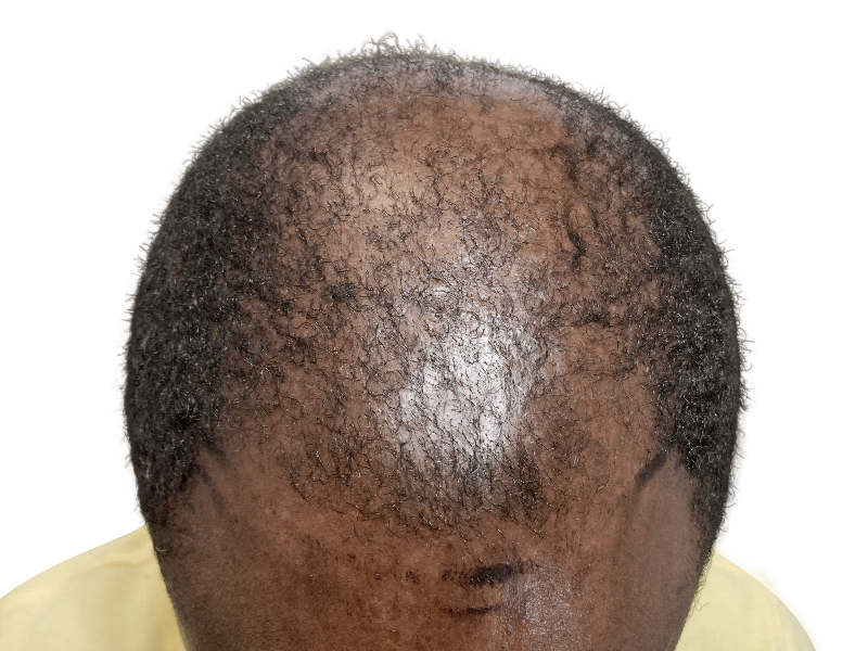 Hair thinning in Black male. Potential hair transplant candidate. Consult for hair restoration options.