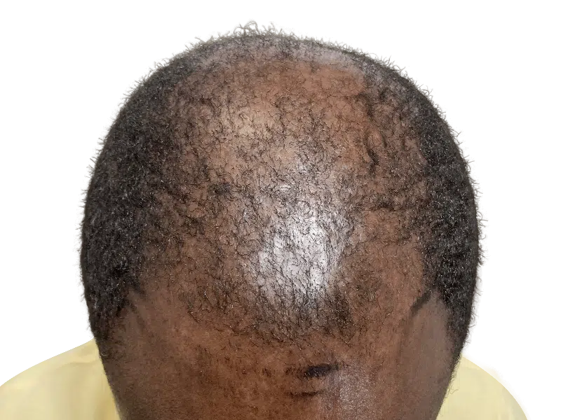 Hair thinning in Black male. Potential hair transplant candidate. Consult for hair restoration options.