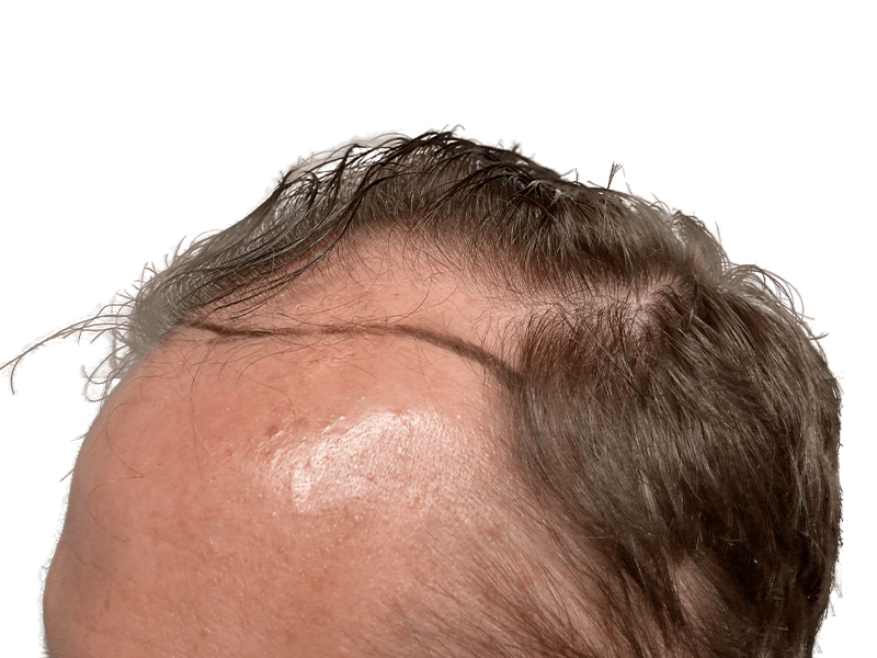 Receding hairline. Gray & brown thinning hair. Hair restoration consultation? Before hair transplant. Caucasian male.