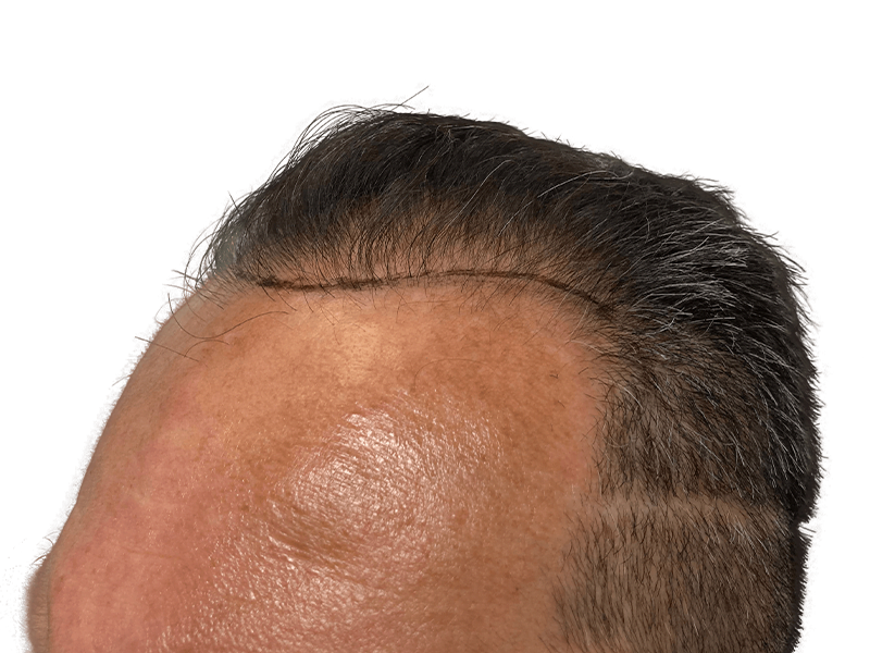 Hair transplant result: Fuller hairline achieved. Before & after visible. Hair restoration success. Caucasian male.
