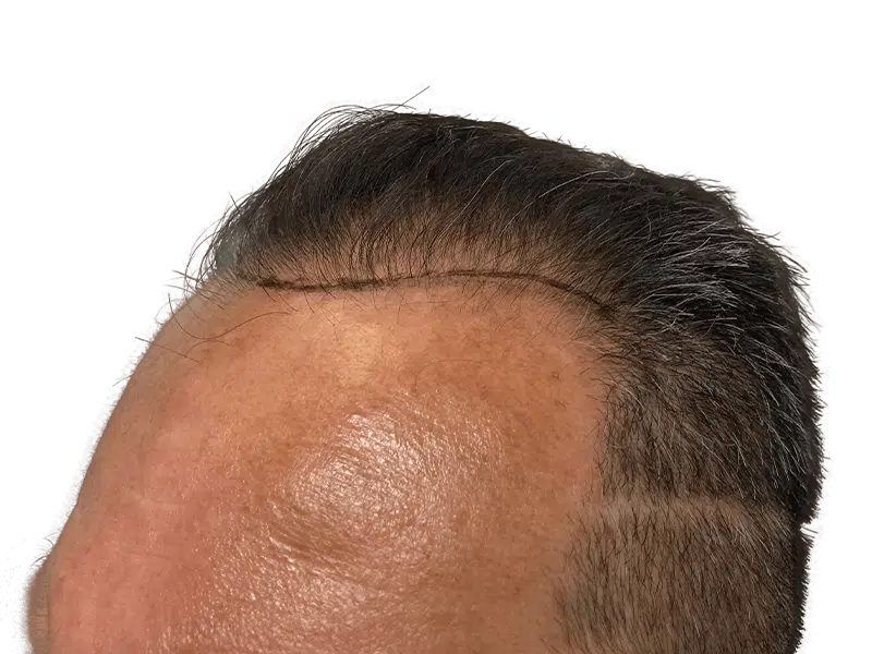 Hair transplant result: Fuller hairline achieved. Before & after visible. Hair restoration success. Caucasian male.
