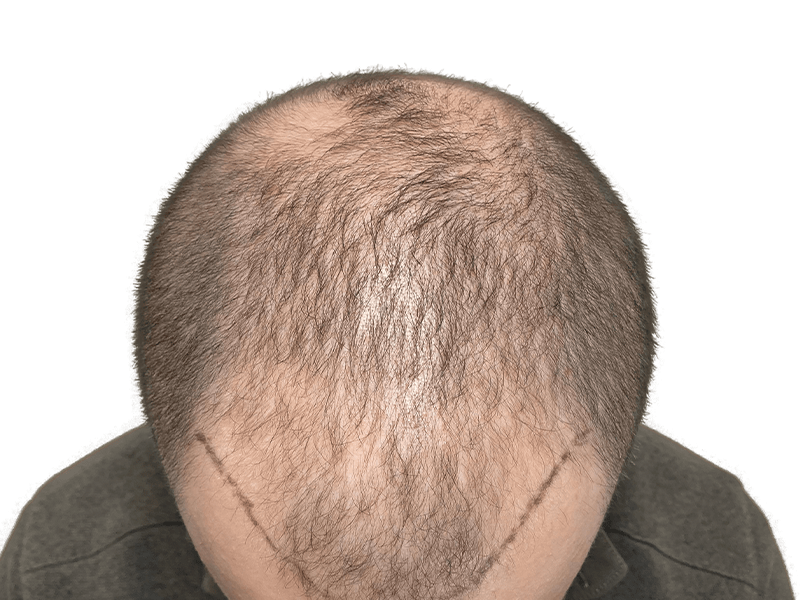 Hair transplant result: Caucasian man's head showing denser hair growth after restoration procedure. Before/after visible.
