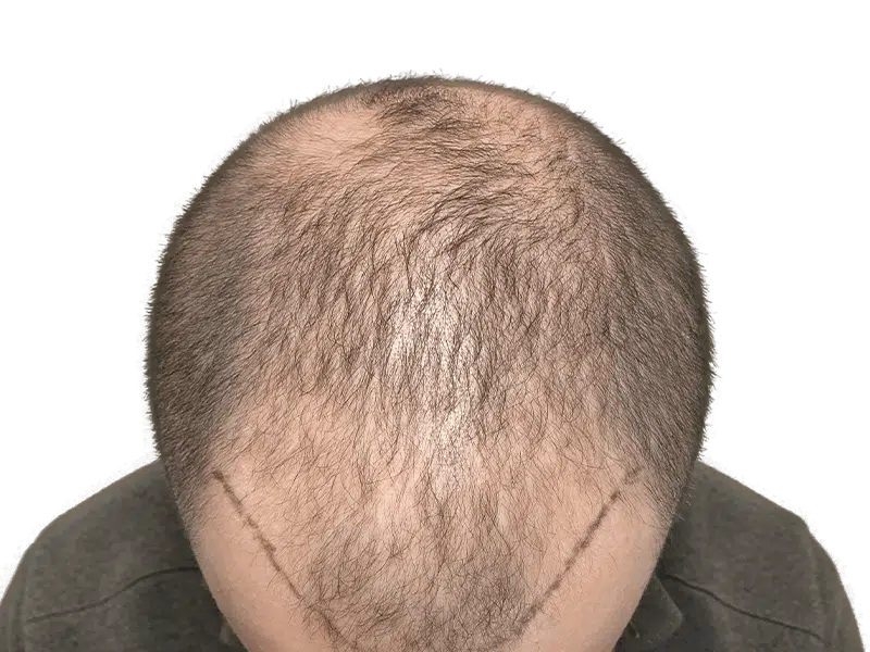 Hair transplant result: Caucasian man's head showing denser hair growth after restoration procedure. Before/after visible.