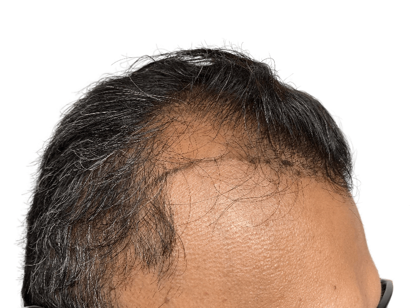 Hair transplant scar on Asian male hairline. Hair restoration result. Before/after comparison possible. Thinning hair addressed.