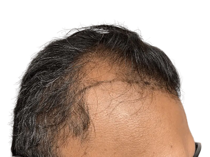 Hair transplant scar on Asian male hairline. Hair restoration result. Before/after comparison possible. Thinning hair addressed.