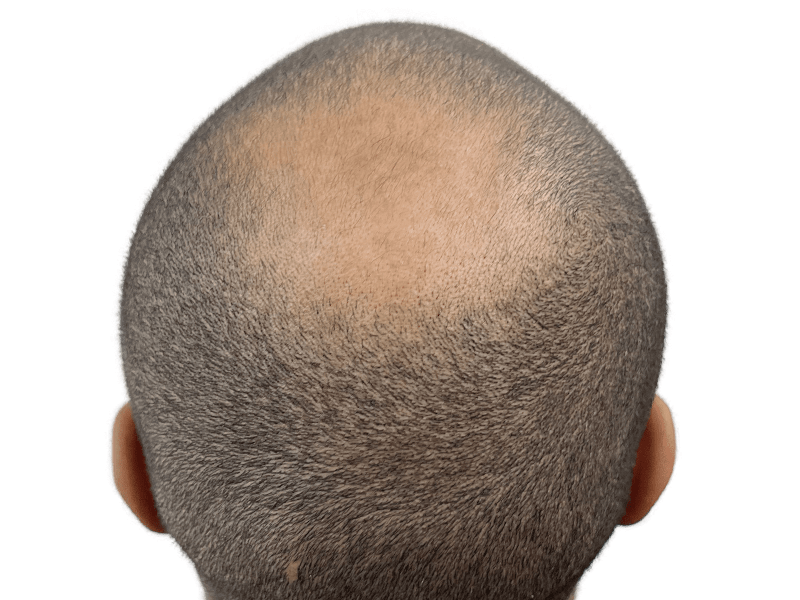 Receding hairline & thinning crown. Hair restoration before photo. Hair transplant candidate. Showing hair loss.