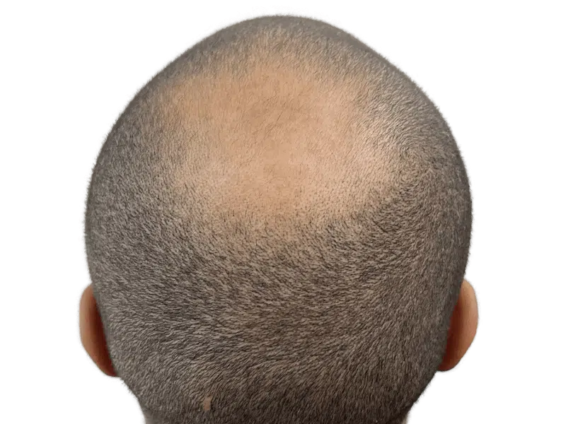 Receding hairline & thinning crown. Hair restoration before photo. Hair transplant candidate. Showing hair loss.