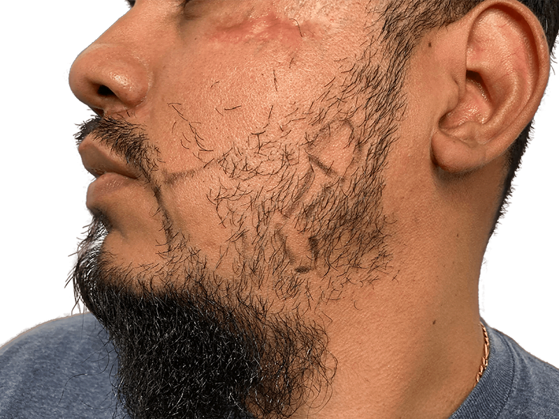 Before: Sparse beard with transplant markings. Hispanic man seeking facial hair restoration. Hair transplant candidate.