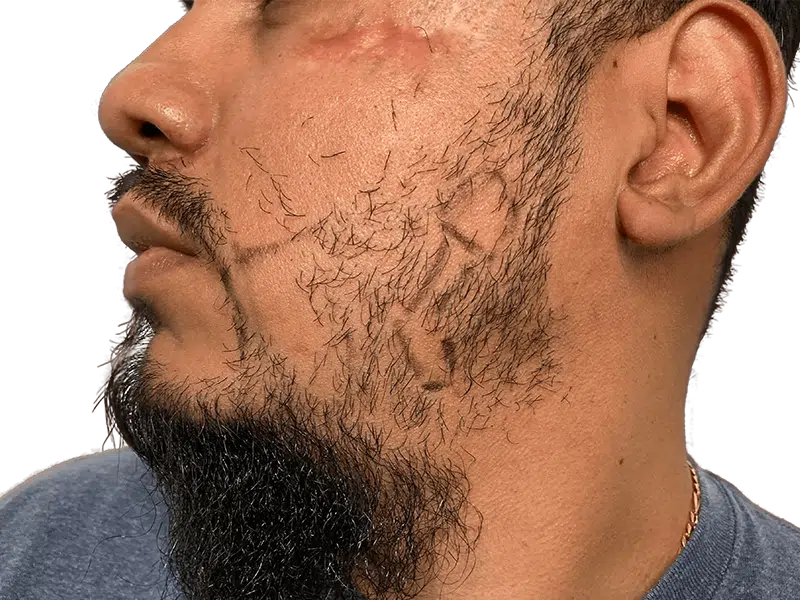 Before: Sparse beard with transplant markings. Hispanic man seeking facial hair restoration. Hair transplant candidate.