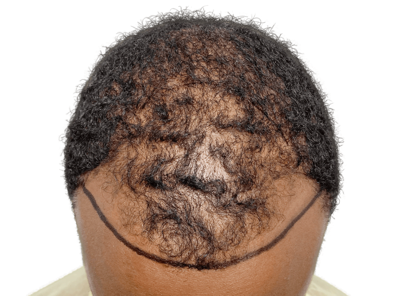 Hair transplant planning: African American man's balding hairline marked before restoration procedure. Sparse hair, before treatment.
