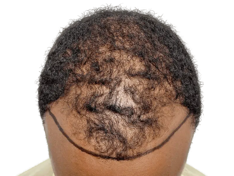 Hair transplant planning: African American man's balding hairline marked before restoration procedure. Sparse hair, before treatment.