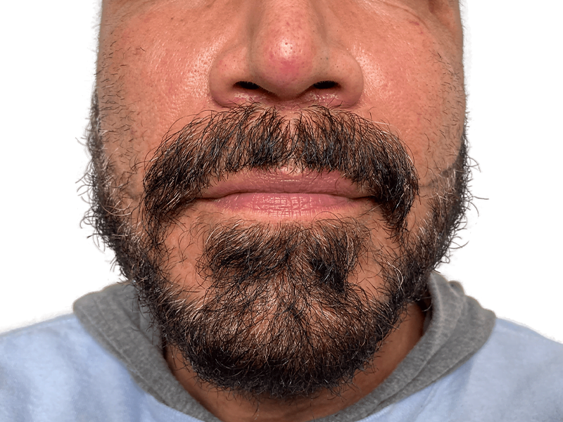 Man with salt & pepper beard. Consider hair restoration? See hair transplant options for beard density & coverage.