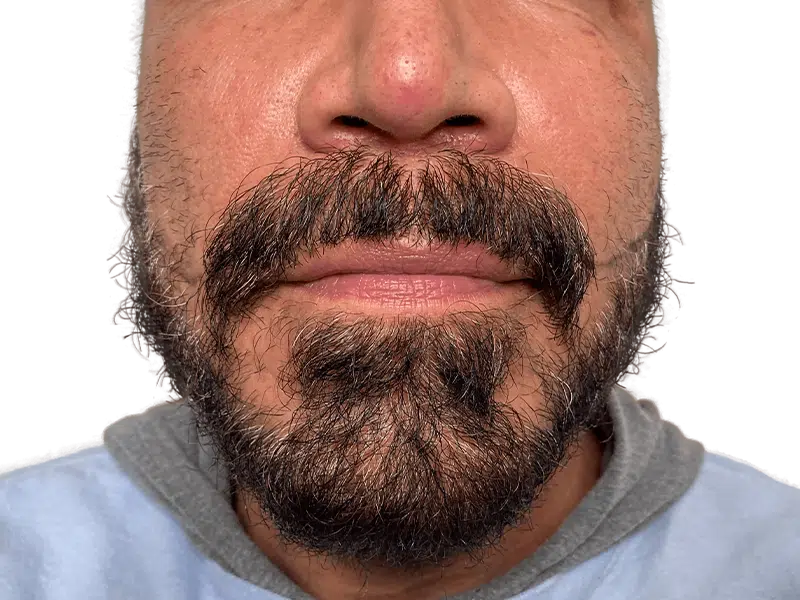 Man with salt & pepper beard. Consider hair restoration? See hair transplant options for beard density & coverage.