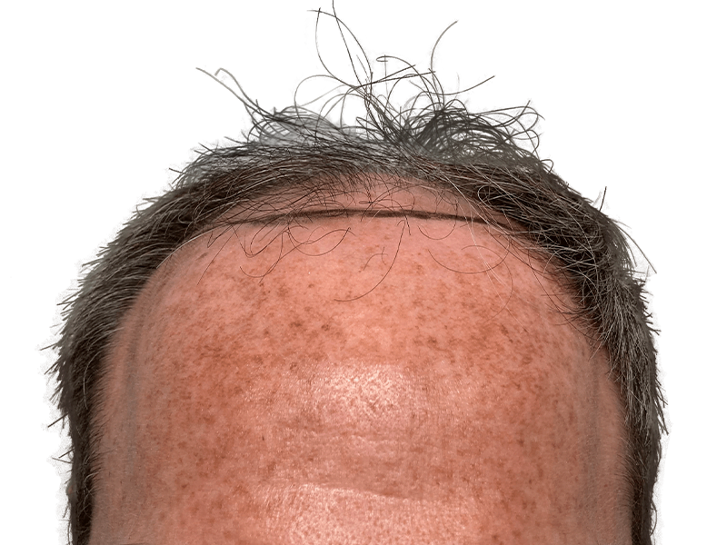 Hair restoration before & after: Receding hairline with thinning, graying hair. Potential hair transplant results.