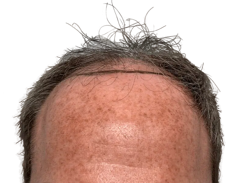Hair restoration before & after: Receding hairline with thinning, graying hair. Potential hair transplant results.