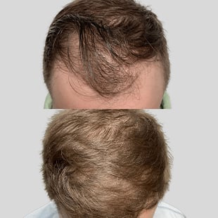 Hair transplant before & after. See visible hair restoration results from our procedure.