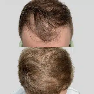 Hair transplant before & after. See visible hair restoration results from our procedure.