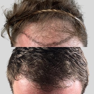 Hair transplant before & after: Thinning hair restored to fuller, thicker hair. Hair restoration results.