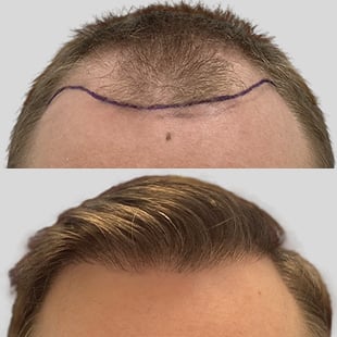 Hair transplant before & after: See restored hairline and fuller hair. Hair restoration results.