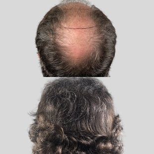 Hair transplant before & after: Noticeable hair restoration results. Improved density covering bald spot. Light skin, dark curly hair.