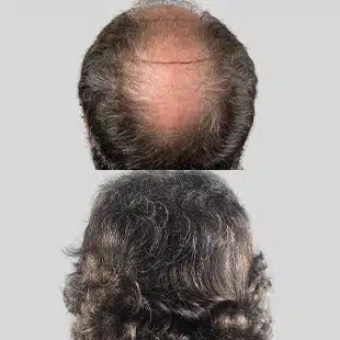 Hair transplant before & after: Noticeable hair restoration results. Improved density covering bald spot. Light skin, dark curly hair.