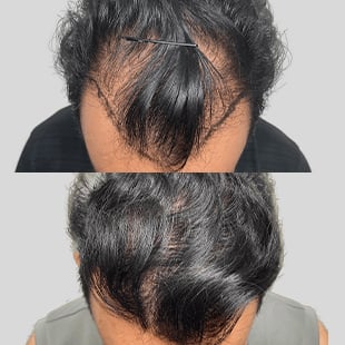 Hair transplant before & after: See fuller, thicker hair after restoration. Improved hairline density. Results may vary.