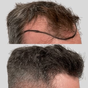 Hair transplant before & after: Caucasian male with receding hairline. See fuller, restored hair after procedure.