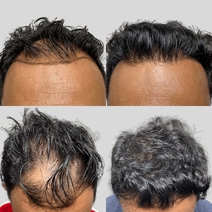 Hair transplant before & after. Dark hair restoration results. See the difference!
