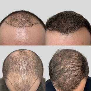 Hair transplant before & after. See dramatic hair restoration results with our advanced procedures.