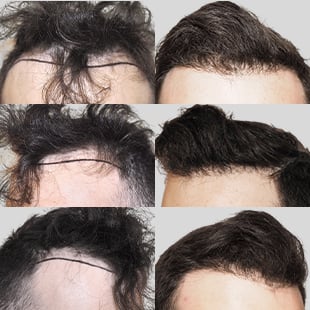 Hair transplant before & after. See natural hair restoration results. Caucasian man, improved hairline.