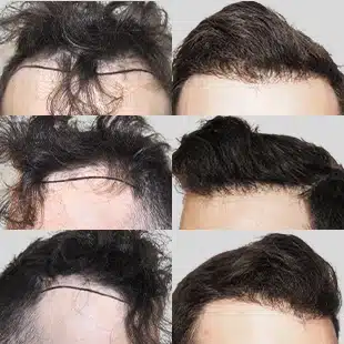 Hair transplant before & after. See natural hair restoration results. Caucasian man, improved hairline.