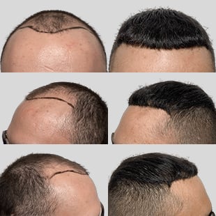 Hair transplant before & after. Caucasian male showing hair restoration results. See the difference!