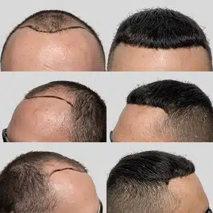 Hair transplant before & after. Caucasian male showing hair restoration results. See the difference!