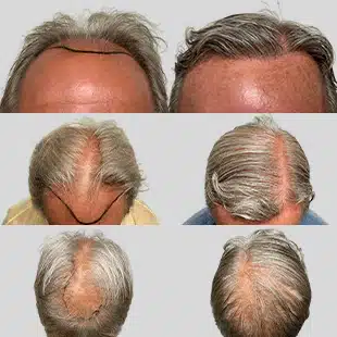 Hair transplant before & after: Caucasian male. Receding hairline & thinning crown restored with hair restoration surgery.
